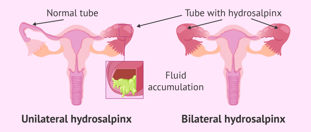 Hydrosalphinx